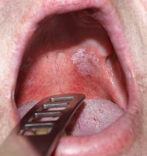 English: Toxic leukoplakia of the oral mucosa ...