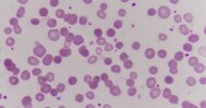 Trovagene updates on acute myeloid leukemia trial for Onvansertib