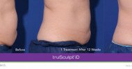Cutera truSculpt iD body sculpting treatment gets expanded approval in Canada