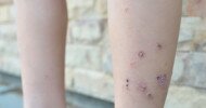 Galderma launches phase 3 atopic dermatitis trial for nemolizumab