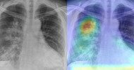 behold.ai red dot algorithm identifies chest x-rays of coronavirus patients as abnormal