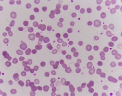 Trovagene updates on acute myeloid leukemia trial for Onvansertib