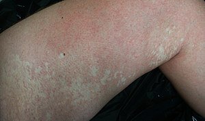 English: Nevus anemicus on the left leg of a man.